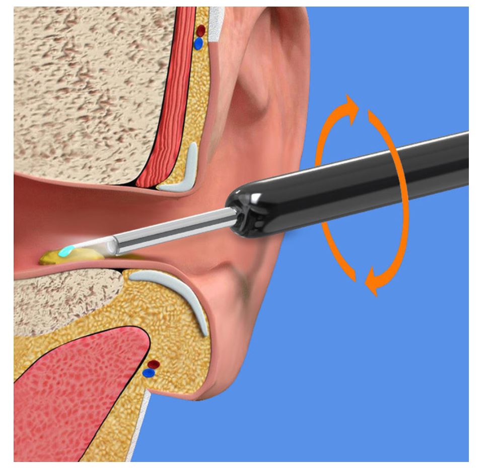 Smart Ear Kit